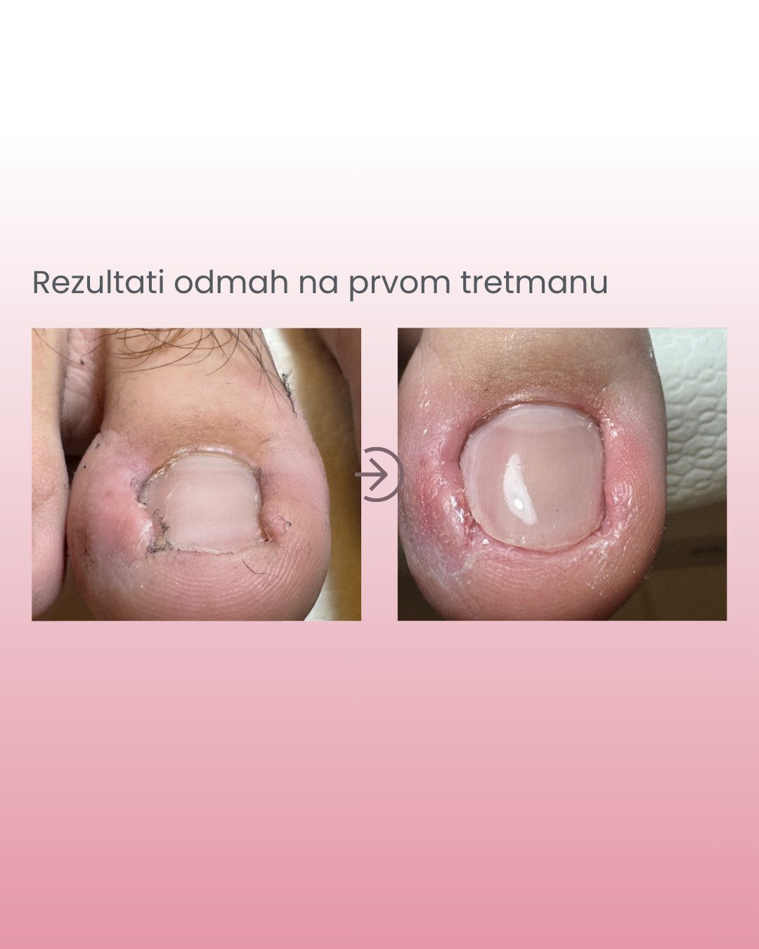 Podizanje rubova nokta do 2 mm