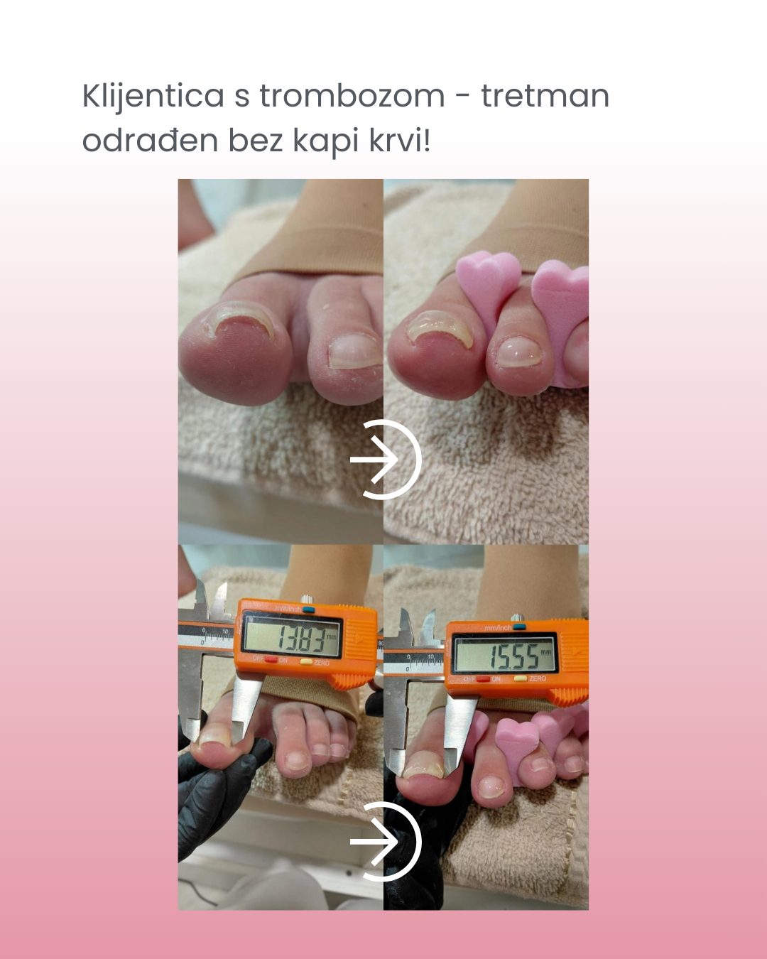 Klijentica s trombozom — tretman bez kapi krvi
