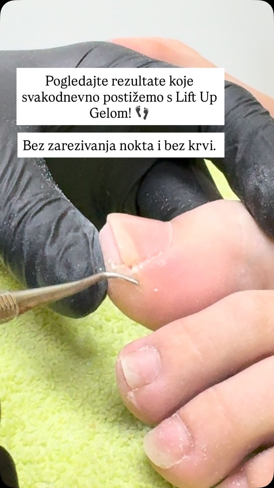 Tretman s Lift Up gelom bez zarezivanja