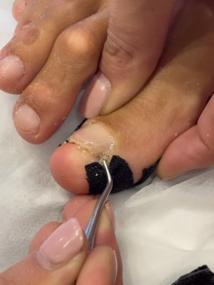 Nanošenje gela — detalj